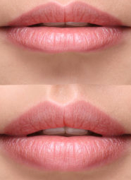 lip plumping and shaping before and after