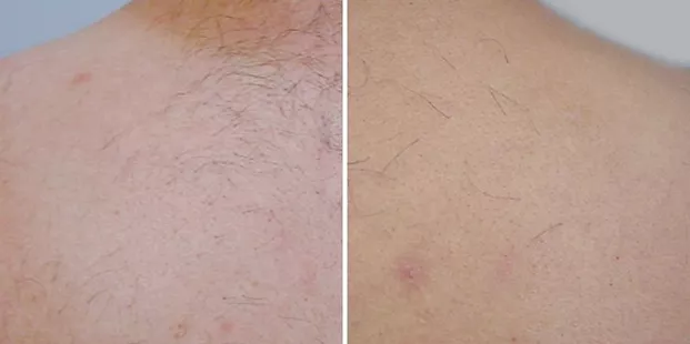 hair-removal-before-and-after