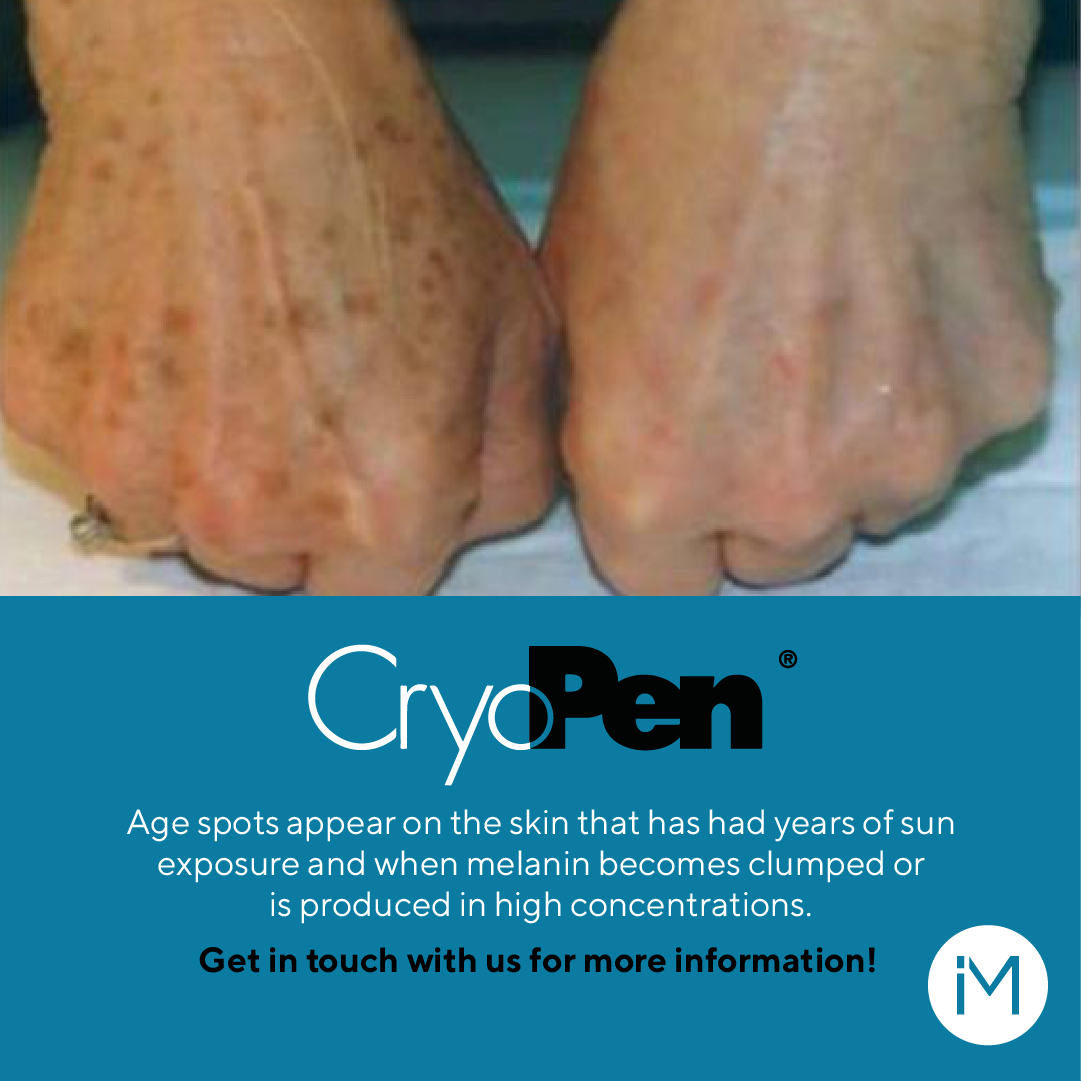 an image of someone's spotted hand before Cryopen Treatment