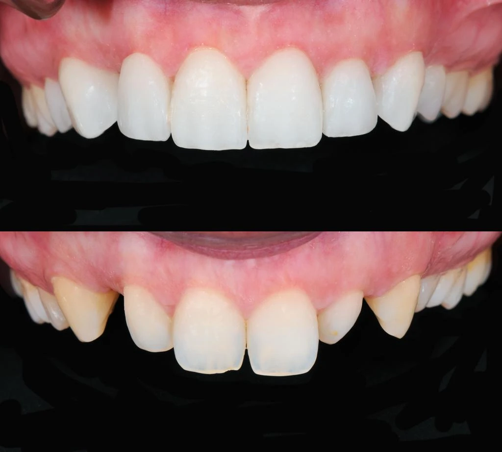 two compiled images of teeth before and after veneers