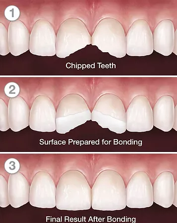 chipped teeth before and after composite bonding in three steps