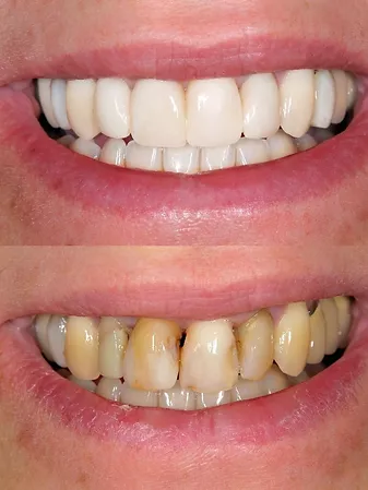 a person's teeth before and after composite bonding