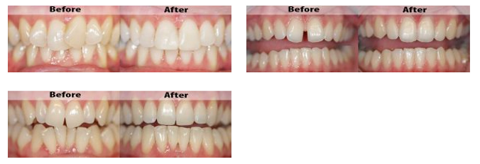 teeth-before-and-after-2