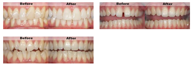 images taken of teeth; before and after surgical processes