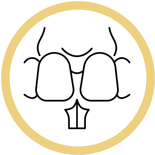 a graphic drawn image of composite dental bonding