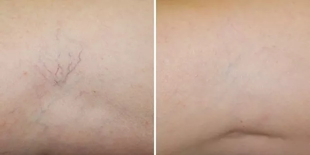 Before and after spider vein treatment on skin